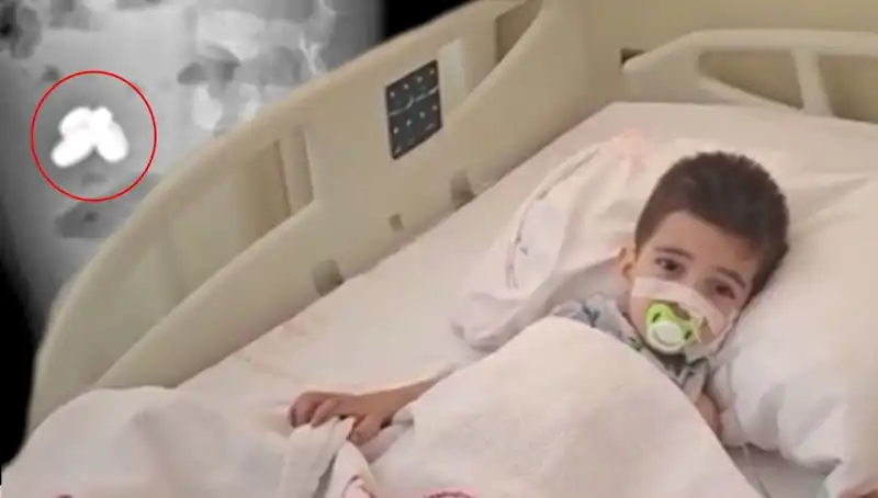 Küçük Çocuğun Bağırsağını Yakan Pil ve Mıknatıs Krizi